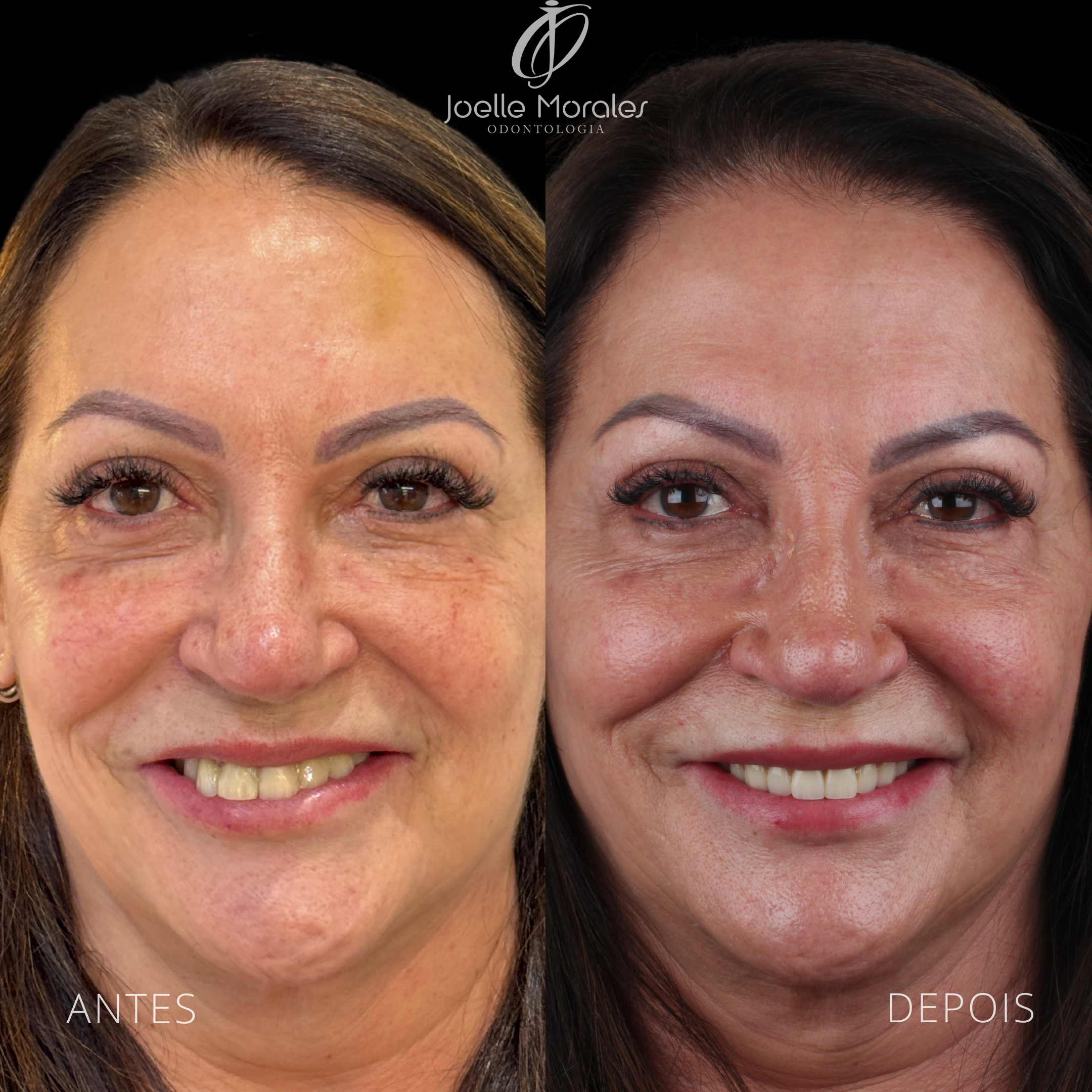 Antes e depois 5