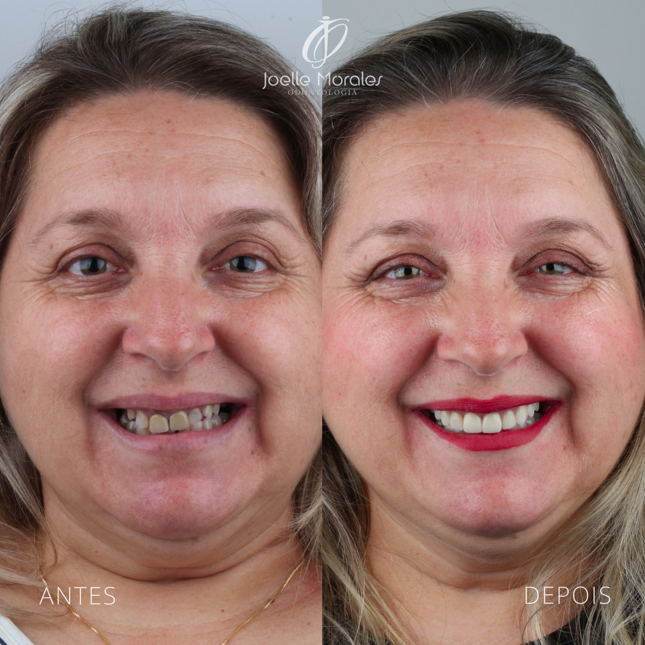Antes e depois 1
