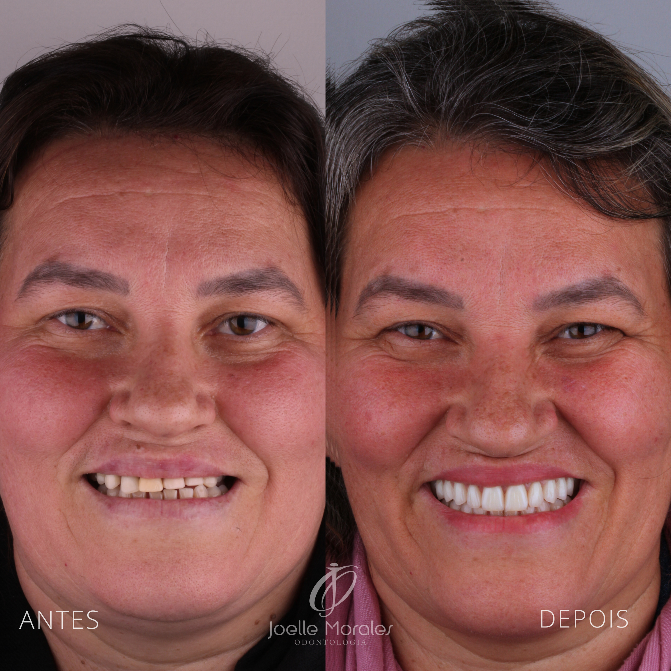 Antes e depois 2
