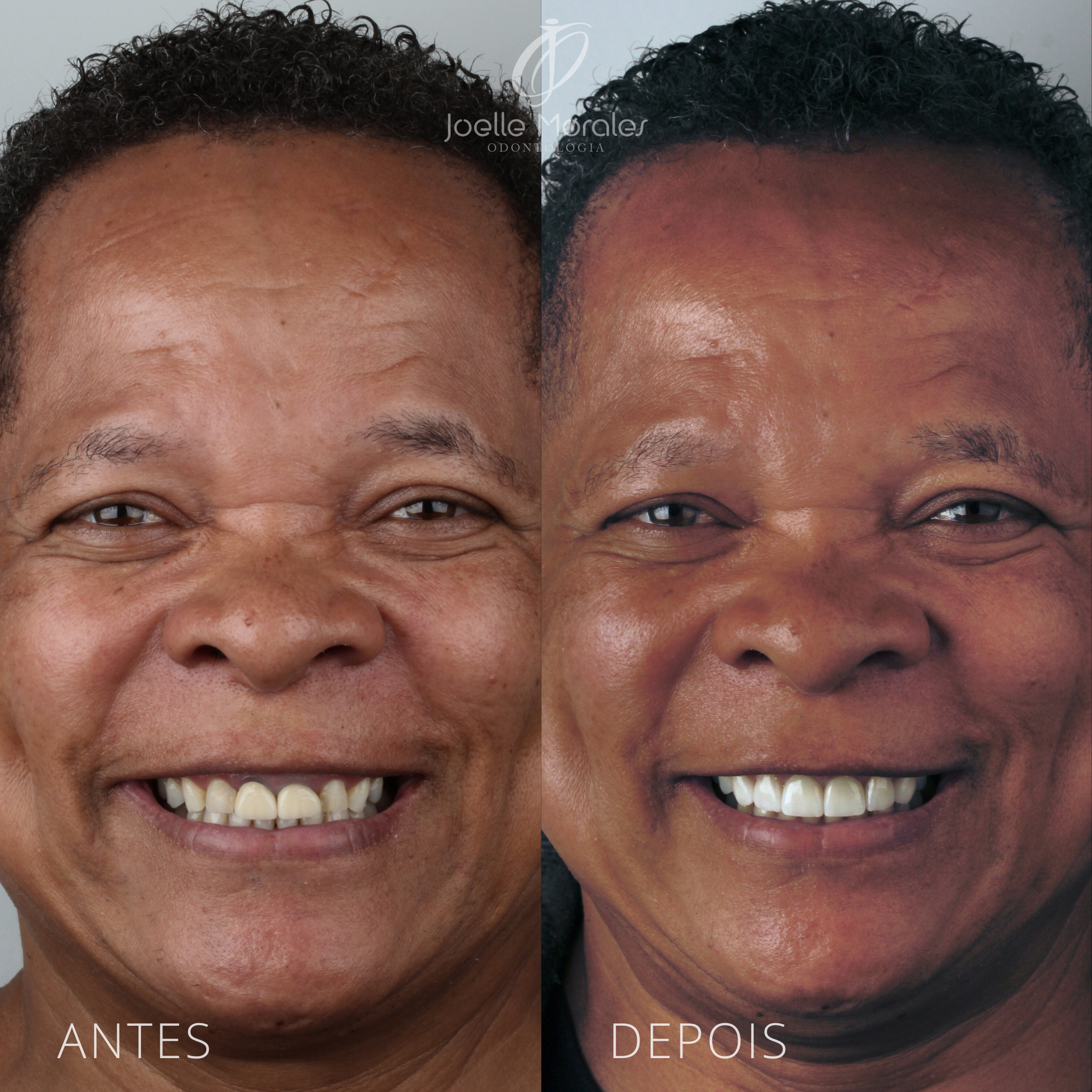 Antes e depois 4