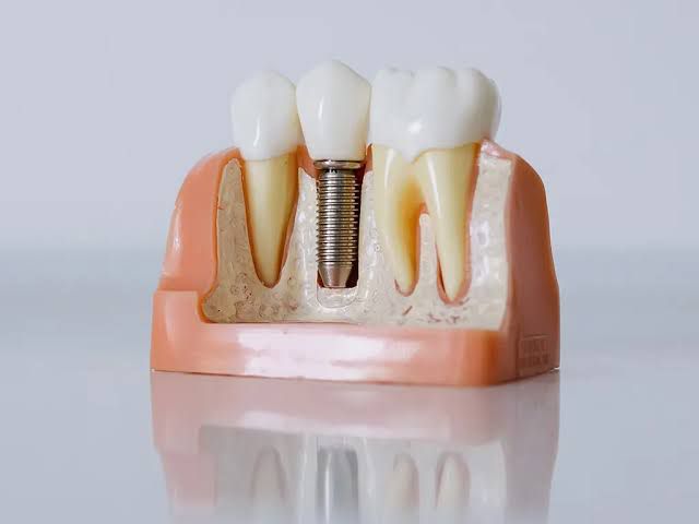 Implante Dentário